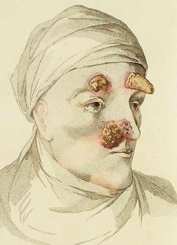 Illustration of a man's face with severe disfigurements due to syphilis