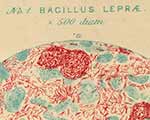 Drawing of leprosy bacilli