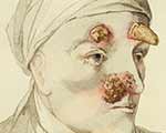 Detail of an illustration of the face of someone with syphilis